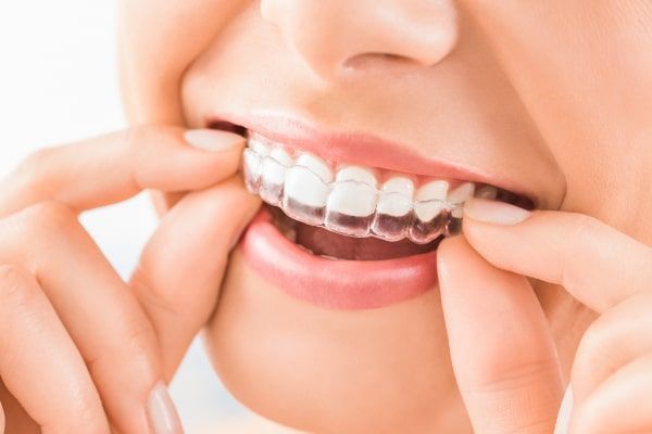 Worn Down Teeth Repair Treatment in Nowra NSW