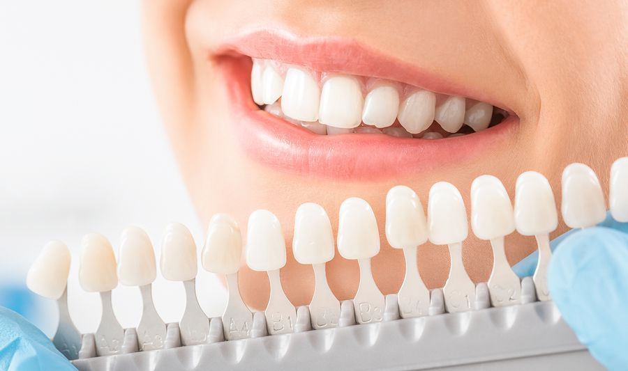 Teeth Whitening — Nowra NSW — Amazing Dental