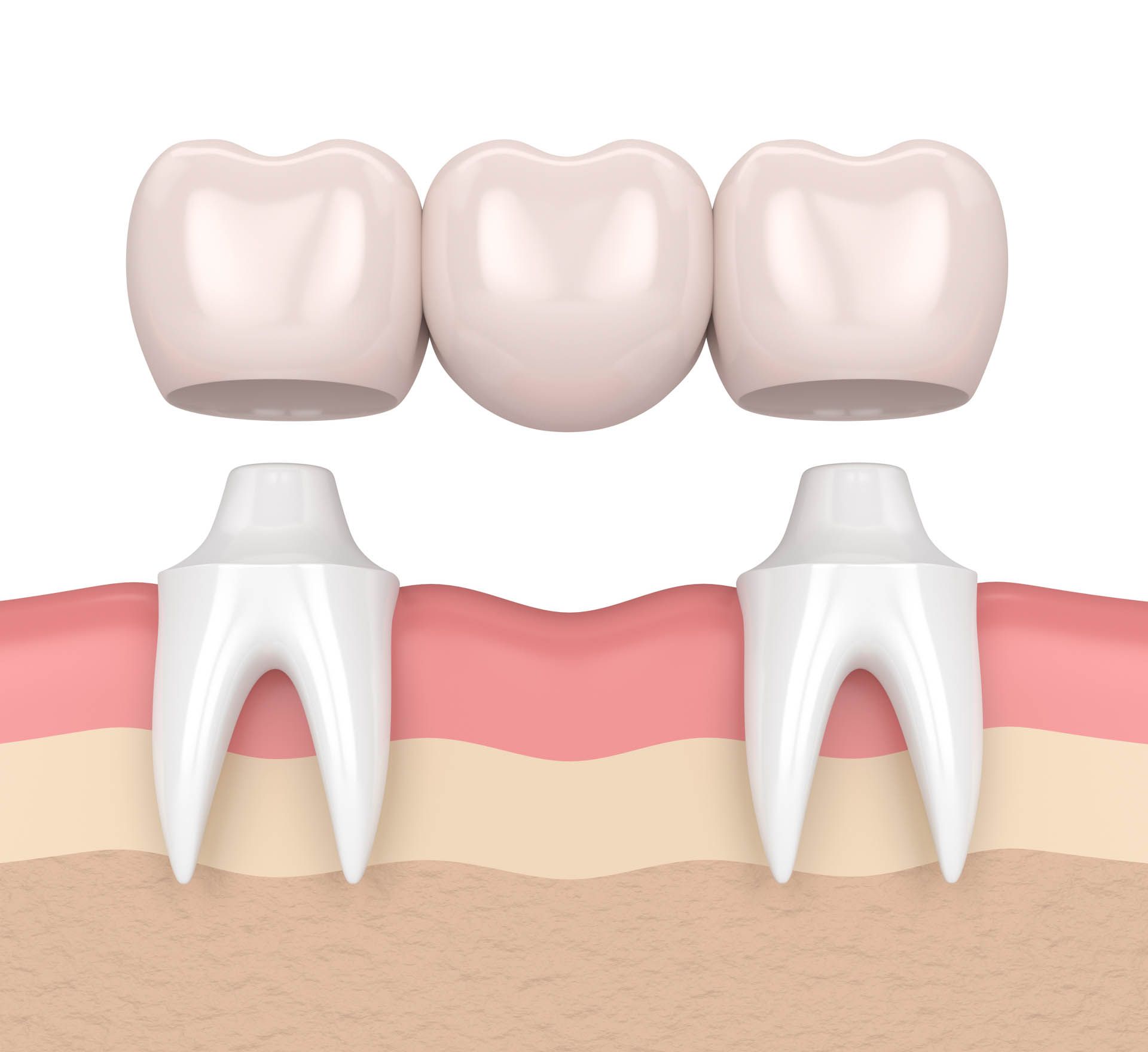 Dental Bridges For Missing Teeth — Nowra NSW — Amazing Dental