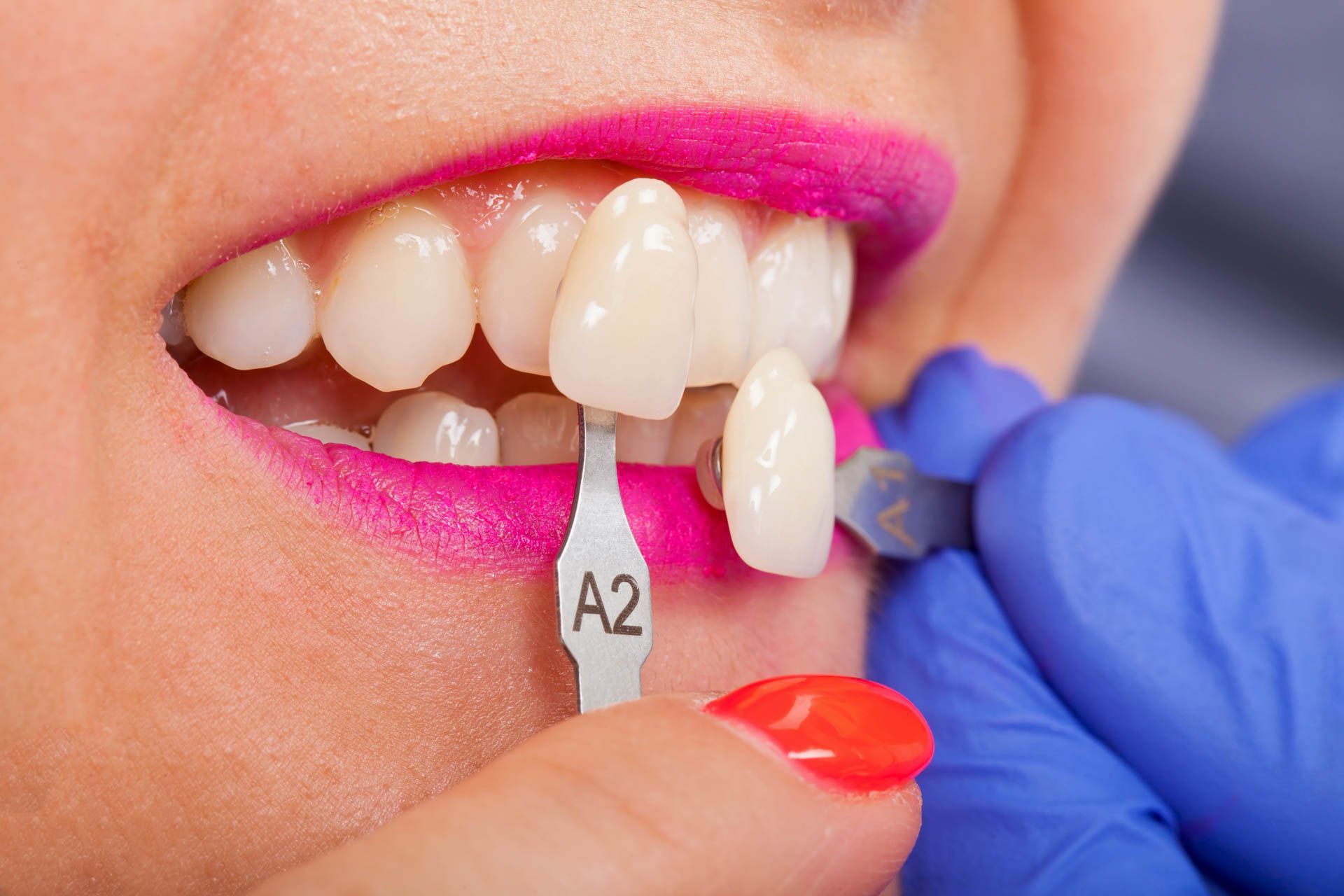 Dental Veneers — Nowra NSW — Amazing Dental