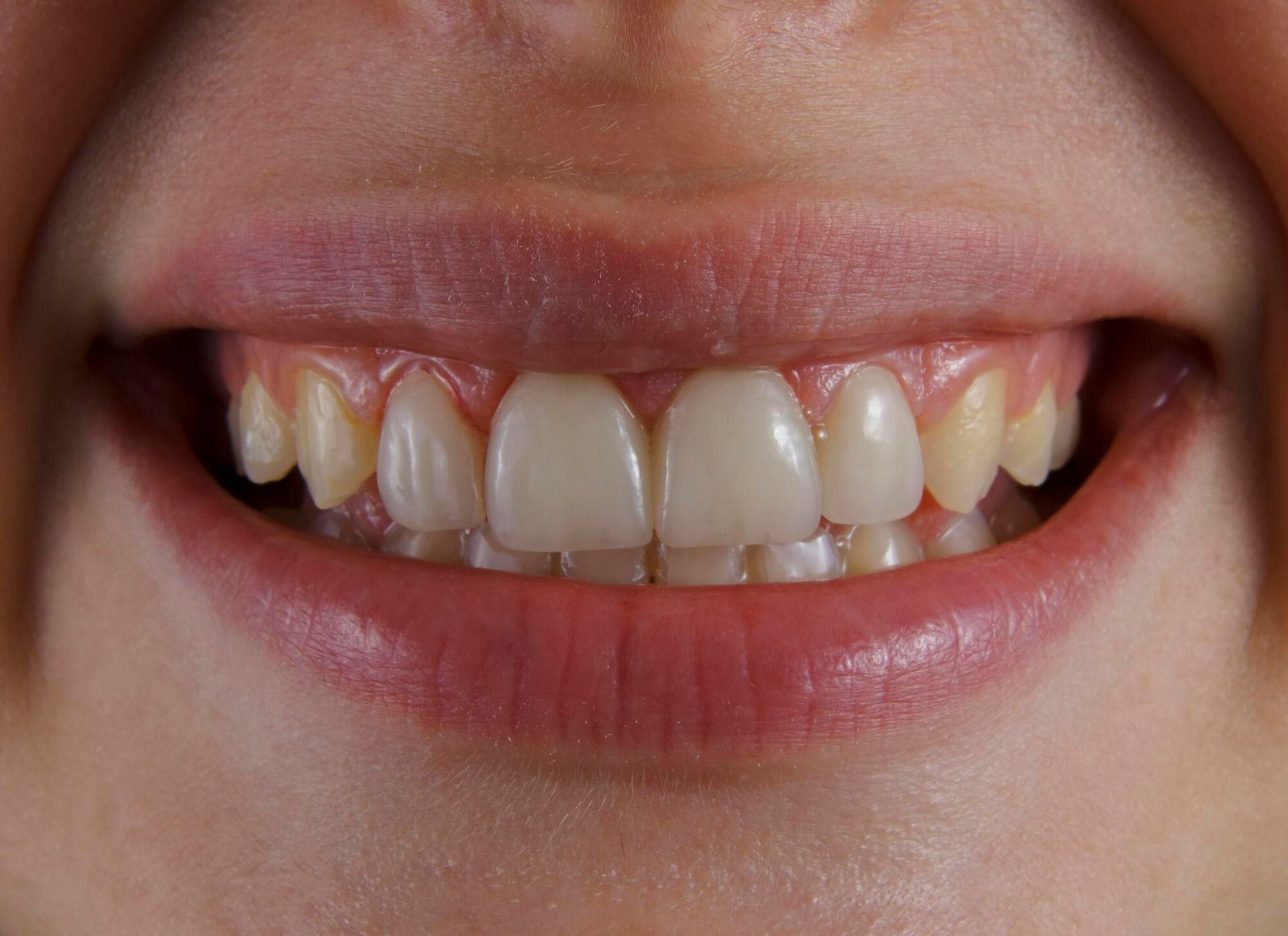 A close up of a person 's teeth with a smile on their face.