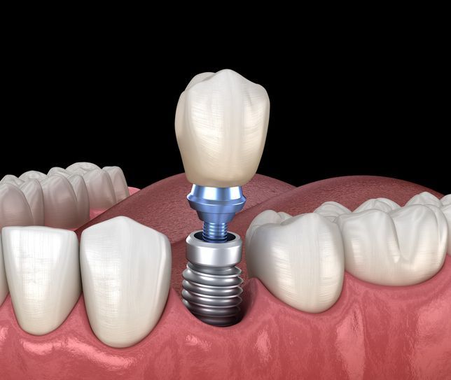 A computer generated image of a dental implant in a person 's mouth.