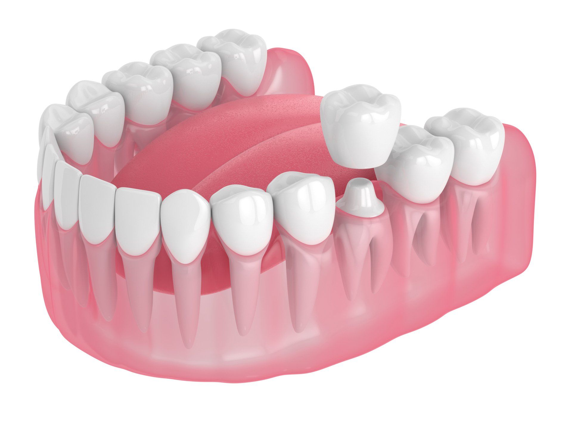 A 3d rendering of a dental bridge in a mouth.