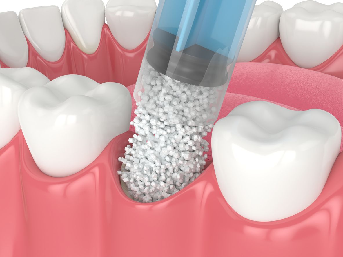 Dental illustration: Injecting bone graft material into a tooth socket.
