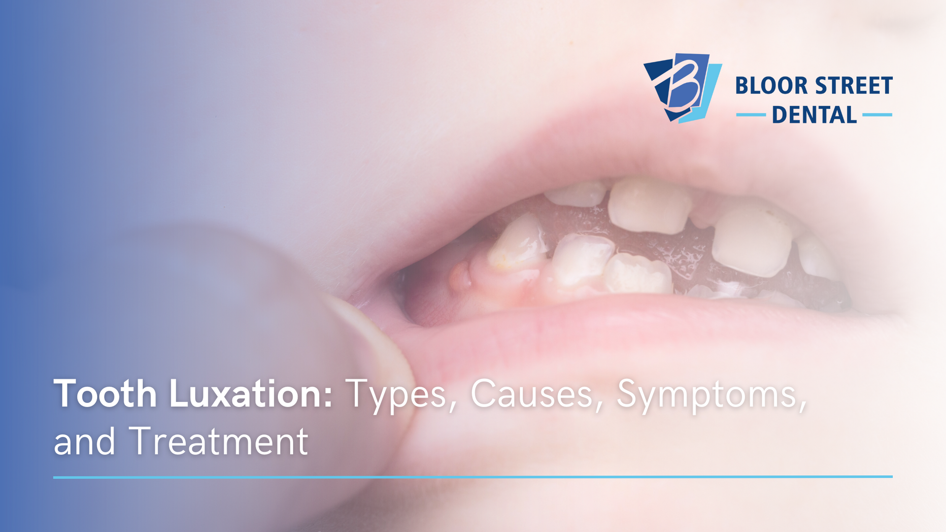 a close up of a person 's mouth with tooth luxation types causes symptoms and treatment