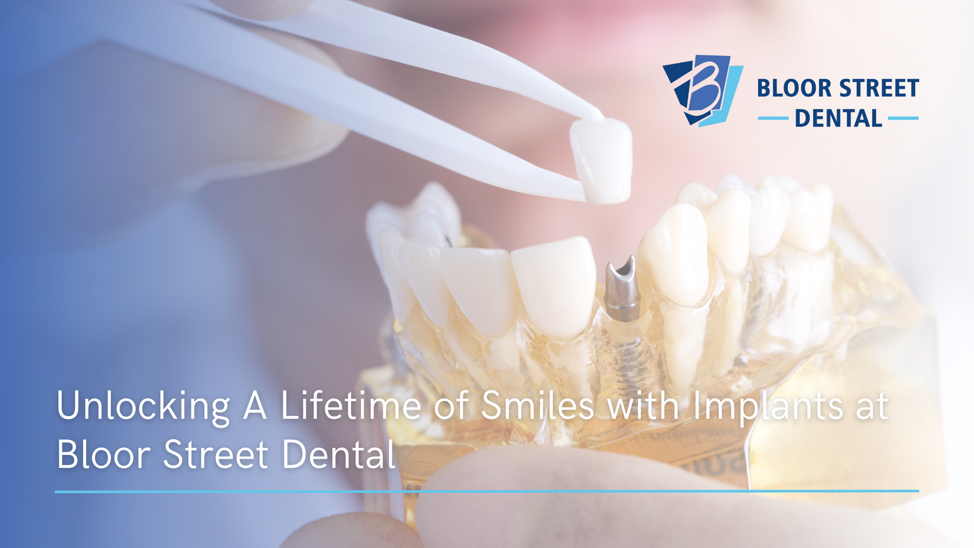 a person is unlocking a lifetime of smiles with implants at bloor street dental .