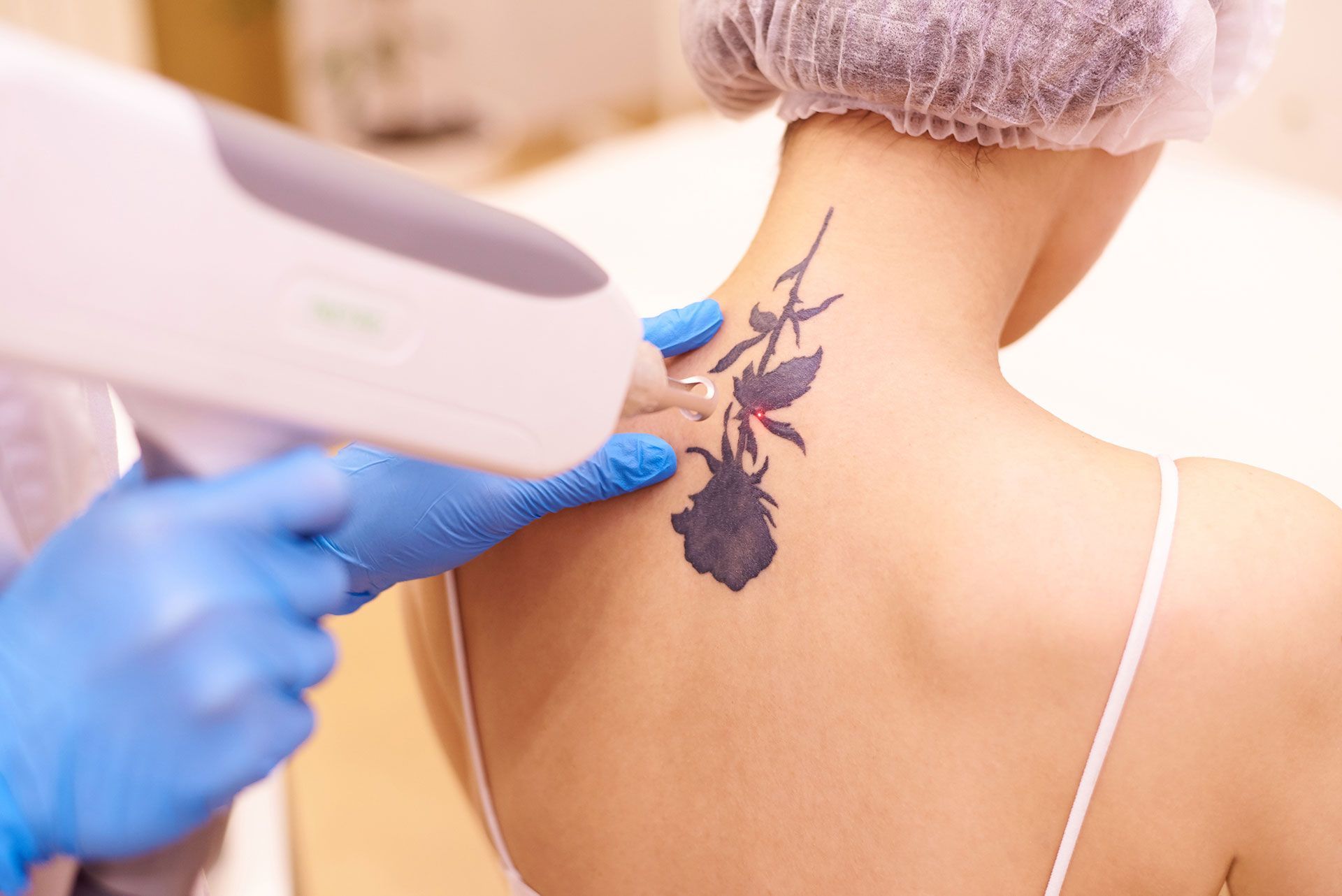 Laser tattoo removal in a cosmetology clinic