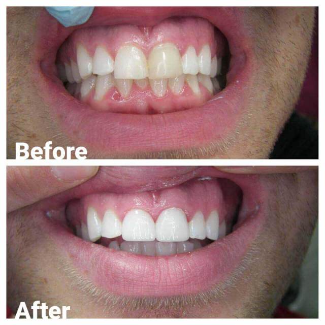 Teeth Cleaning — Before and After Teeth Cleaning in Royal Oak, MI