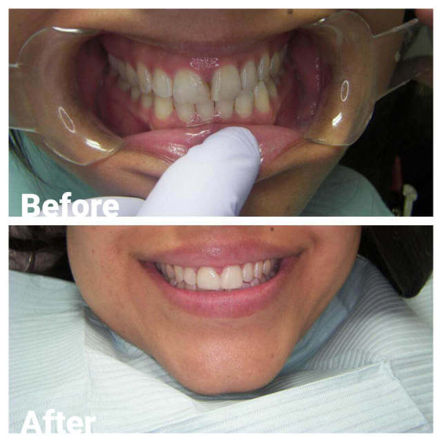 Cosmetic Dentistry — Before and After Teeth Whitening in Royal Oak, MI