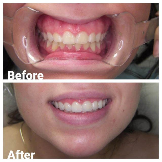 Restorative Dentistry — Before and After Dental Treatment in Royal Oak, MI