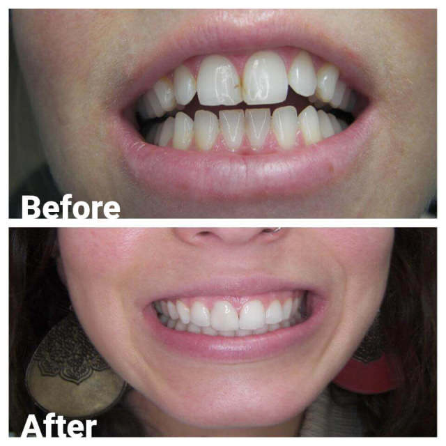 Periodontics — Before and After Teeth Aligning in Royal Oak, MI