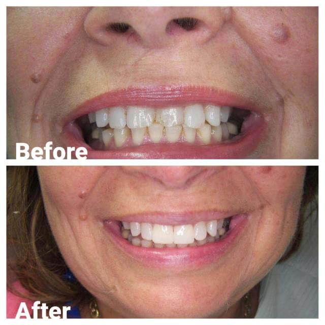 Dentures — Before and After Denture in Royal Oak, MI
