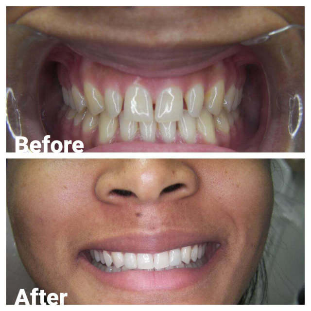 Invisalign — Before and After Invisalign in Royal Oak, MI