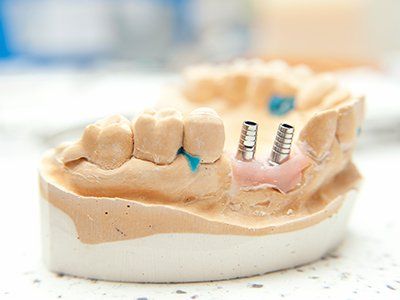 Dental Implants —Tooth Implants in Royal Oak, MI
