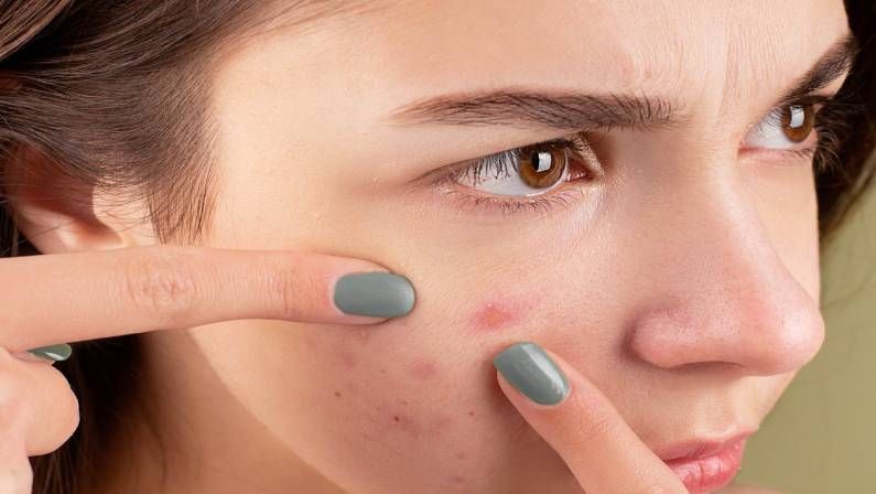Woman Squeezing Her Acne or Pimples with Her Fingers