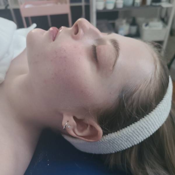 Skin treatments for glowing skin