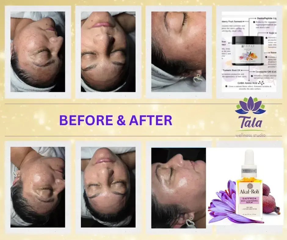 Before and after facial skincare treatment results at Tala Wellness Studio, a day spa in Summerville, SC, showing improved skin clarity and glow.