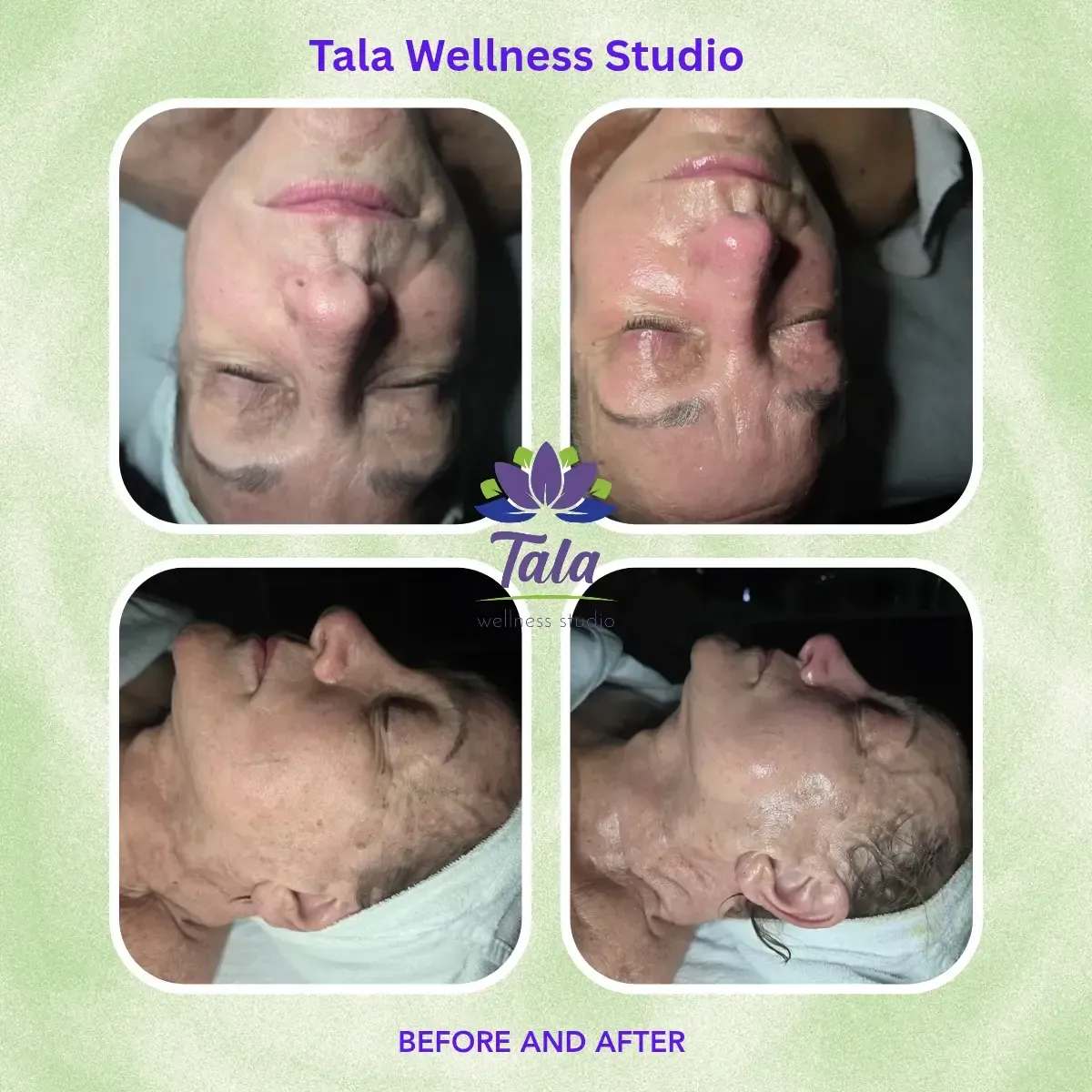 Before and after facial results at Tala Wellness Studio showing improved skin texture at a day spa in Summerville SC.