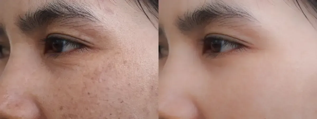 sun-damaged skin treatment