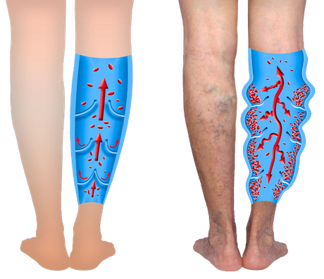 Diagram showing healthy leg circulation on left and varicose veins on right. Red arrows indicate blood flow.