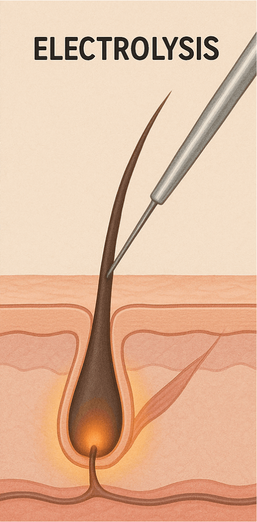 Illustration showing electrolysis process. A needle is inserted into a hair follicle to destroy the hair root.