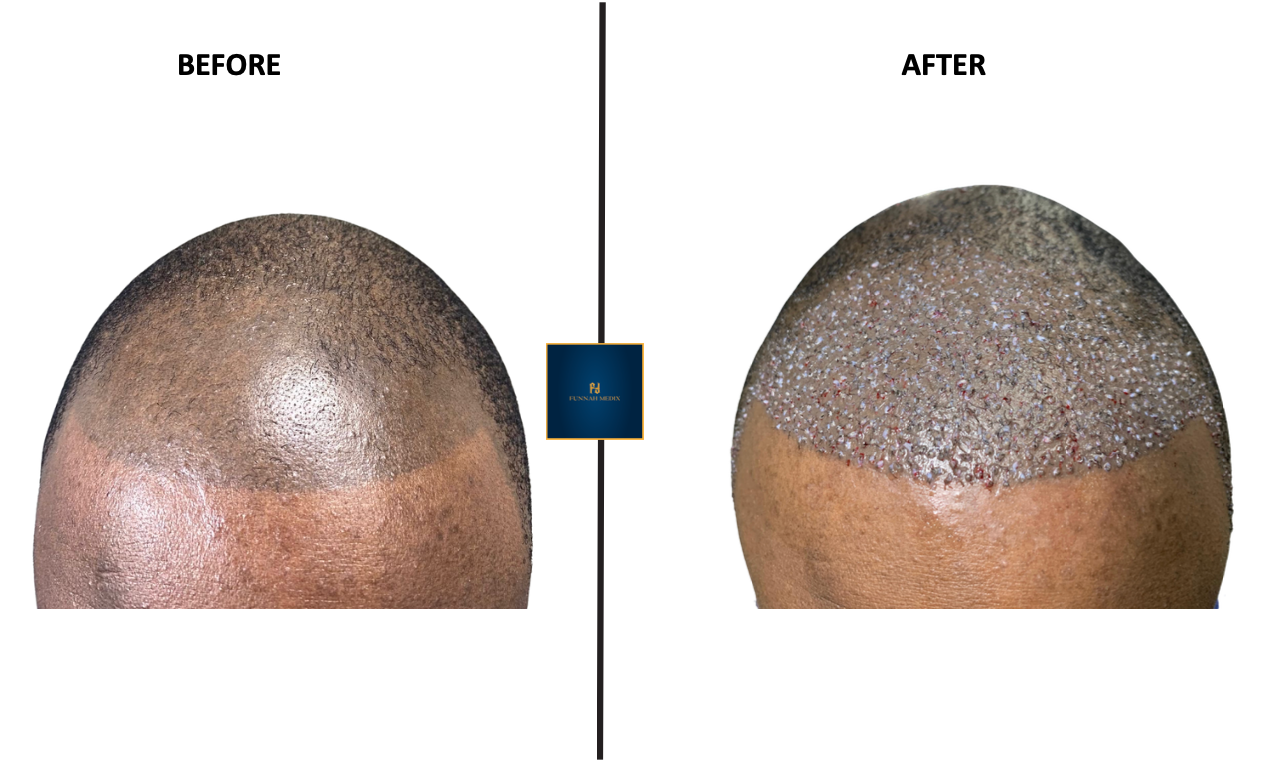 Before and after hair transplant