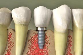 dental implants; dental services; dental treatment; Bischoff Family Dentistry; Peoria, AZ dentist; Peoria, AZ 85381