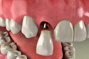 dental implants; dental care; Bischoff Family Dentistry; Peoria, AZ dentist; Peoria, AZ 85381
