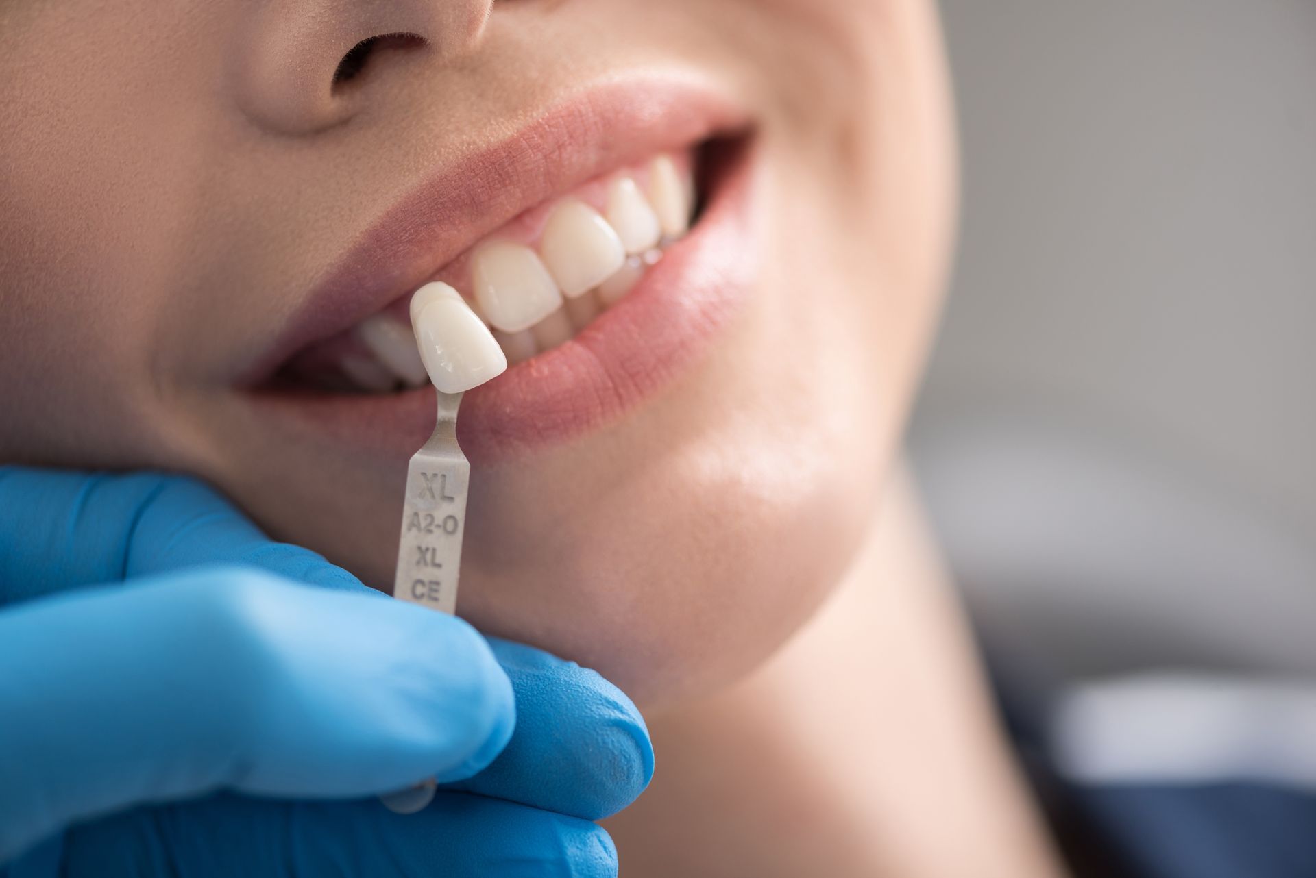 A gloved dentist holds a tooth shade guide against a patient's natural teeth to match their color for dental treatment.