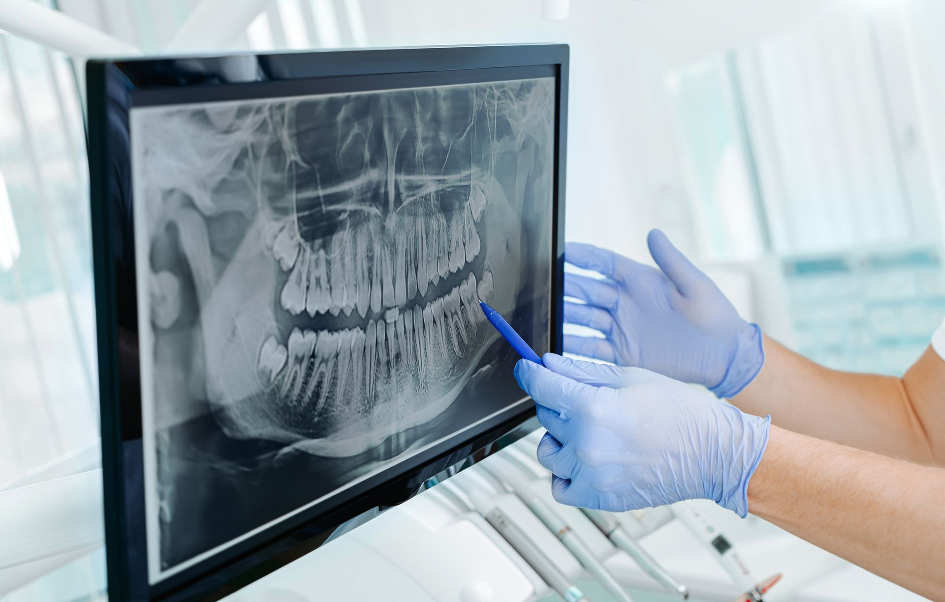 A dentist in blue gloves points to a panoramic dental X-ray displayed on a computer screen in an office.