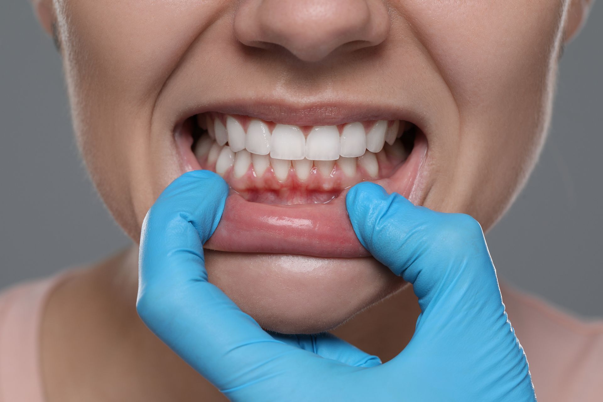 A gloved hand pulls back a lower lip to reveal inflamed, red gums surrounding the lower teeth.