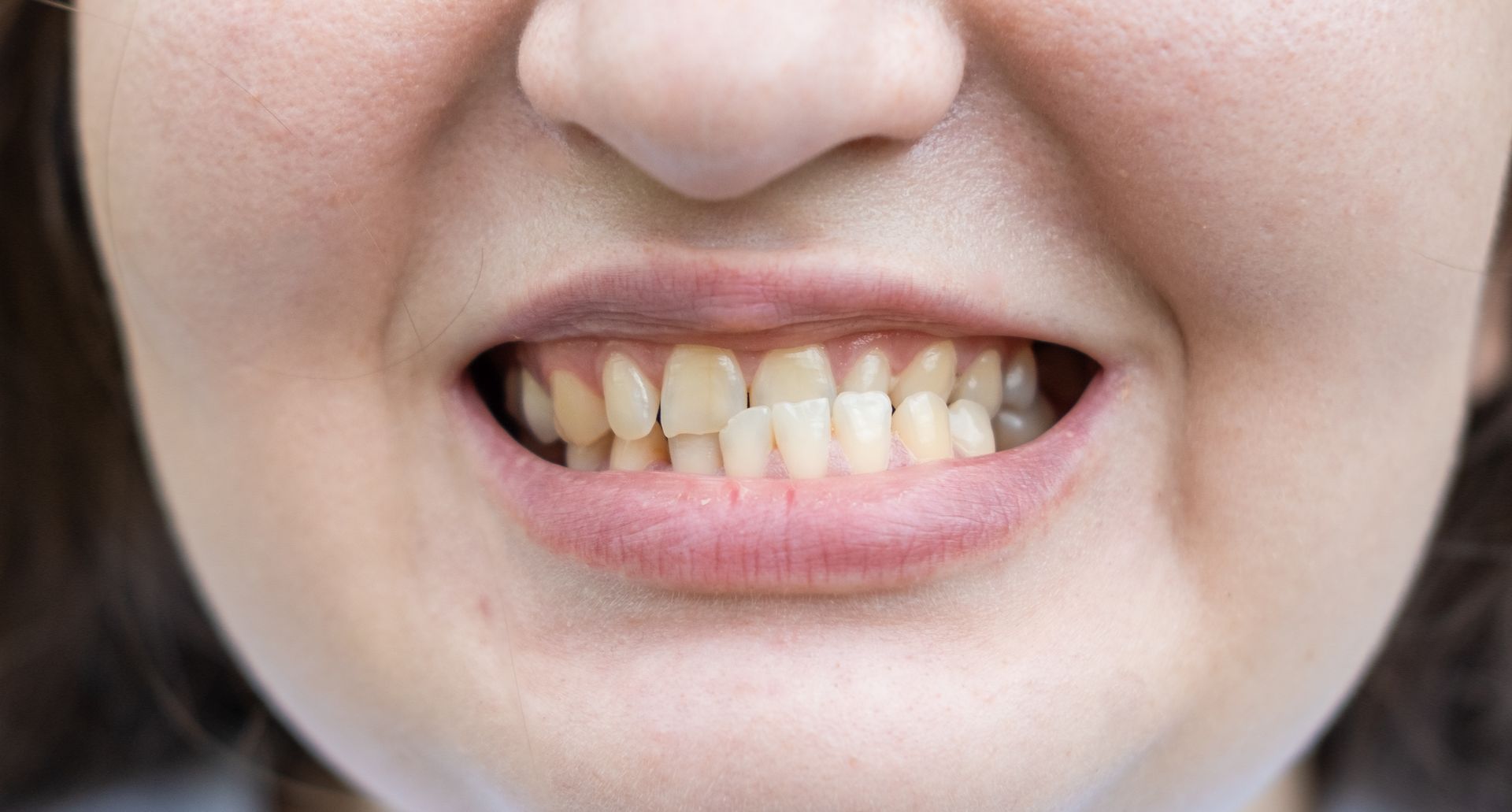 A close-up of a person's mouth showing slightly crowded teeth with yellow staining.