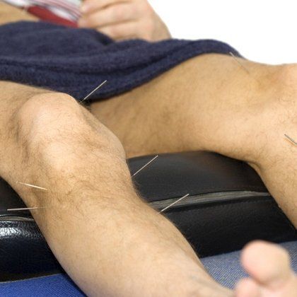 A man lying on a massage table with acupuncture needles in serted into his legs.