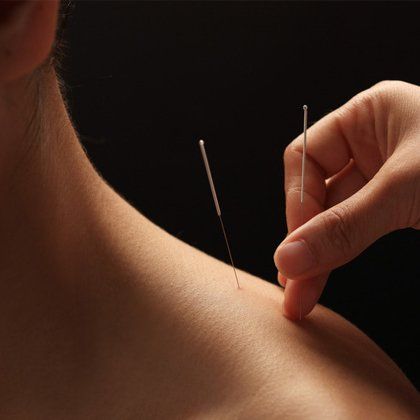 Acupuncture needles being inserted into a lady's shoulder