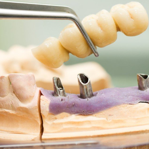 bridge implants inserted into jawbone