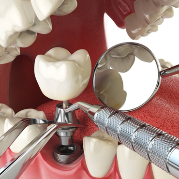 dental implant being inserted into jaw