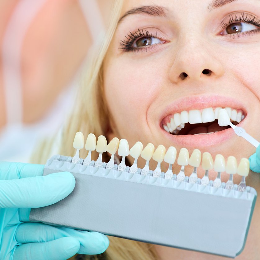 woman having teeth color matched to veneers