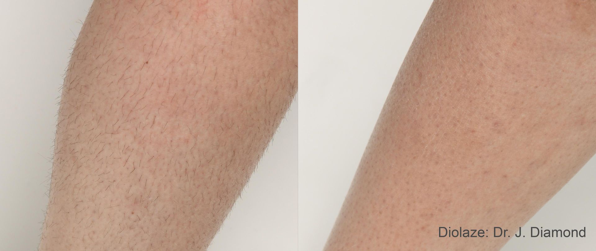 Before and after comparison of a leg, showing hair before and reduced hair after the DiolazeXL laser treatment in Nacogdoches TX