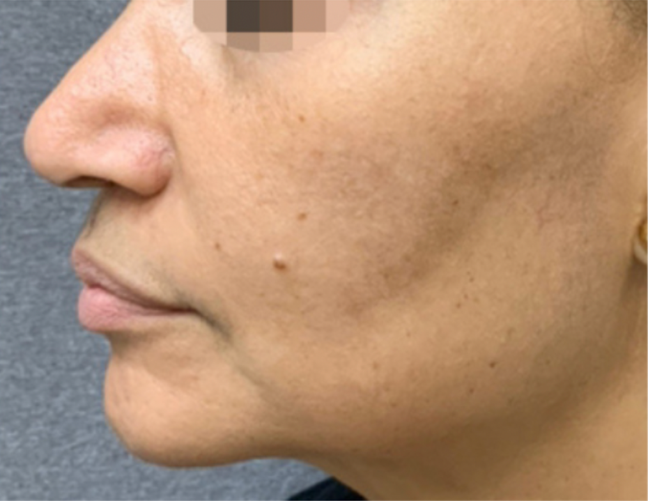 Anti-aging skin therapy at Wagoner Family Health Clinic Nacogdoches TX