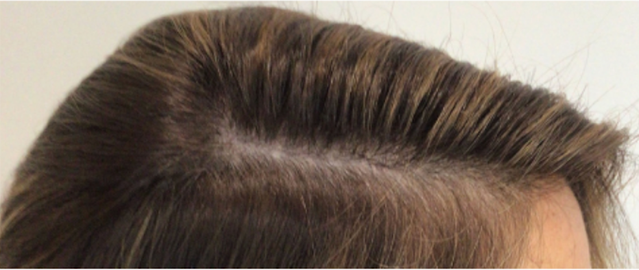 Hair Thinning treatments at Wagoner Family Health Clinic Nacogdoches TX