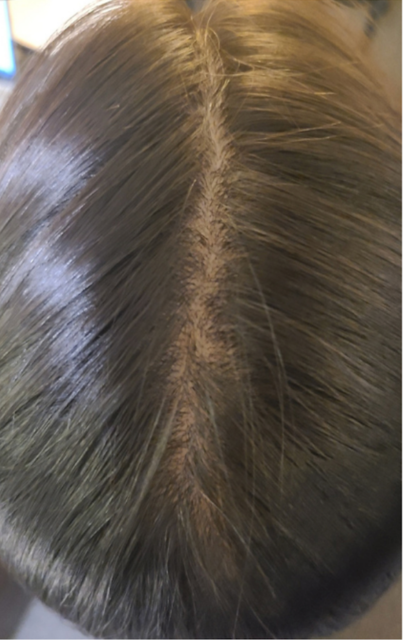 Hair Thinning treatments at Wagoner Family Health Clinic Nacogdoches TX