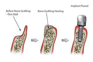 Process of Bone Grafting