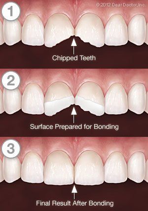 Dental Bonding