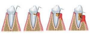Gum Disease