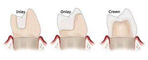 Inlays and Onlays