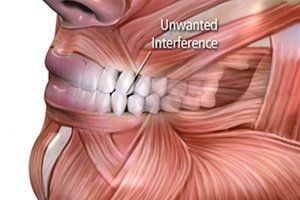 Occlusal Adjustment