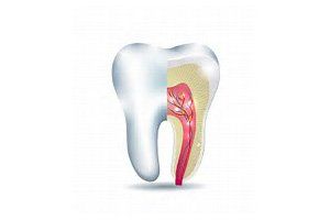 Root Canal Therapy, Illustration of Tooth with Root Canal