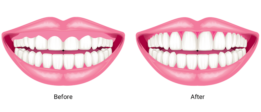 Before and After Cosmetic Gum Surgery