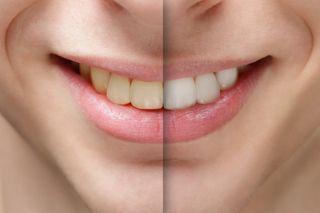 Teeth Whitening; Woman smiling, before and after teeth whitening procedure