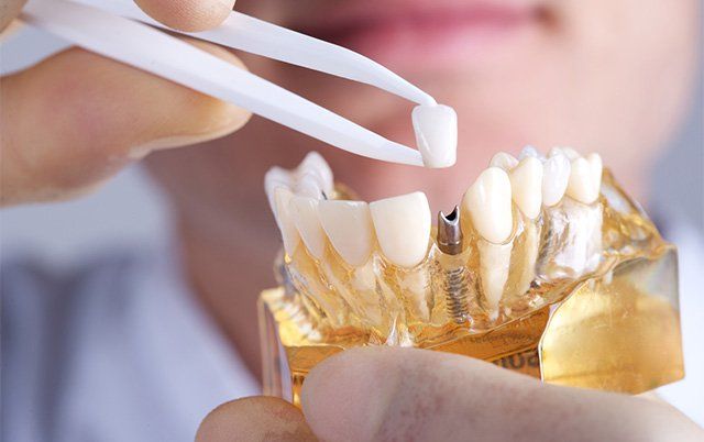 dental implants, Potomac Falls Family Dentistry